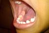 Herpes, The Boy Wonder with his Mouth of Sores